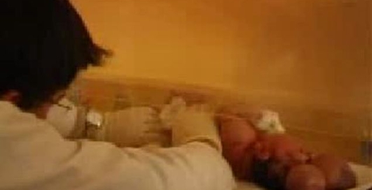 дитина народилася із мозком біля голови