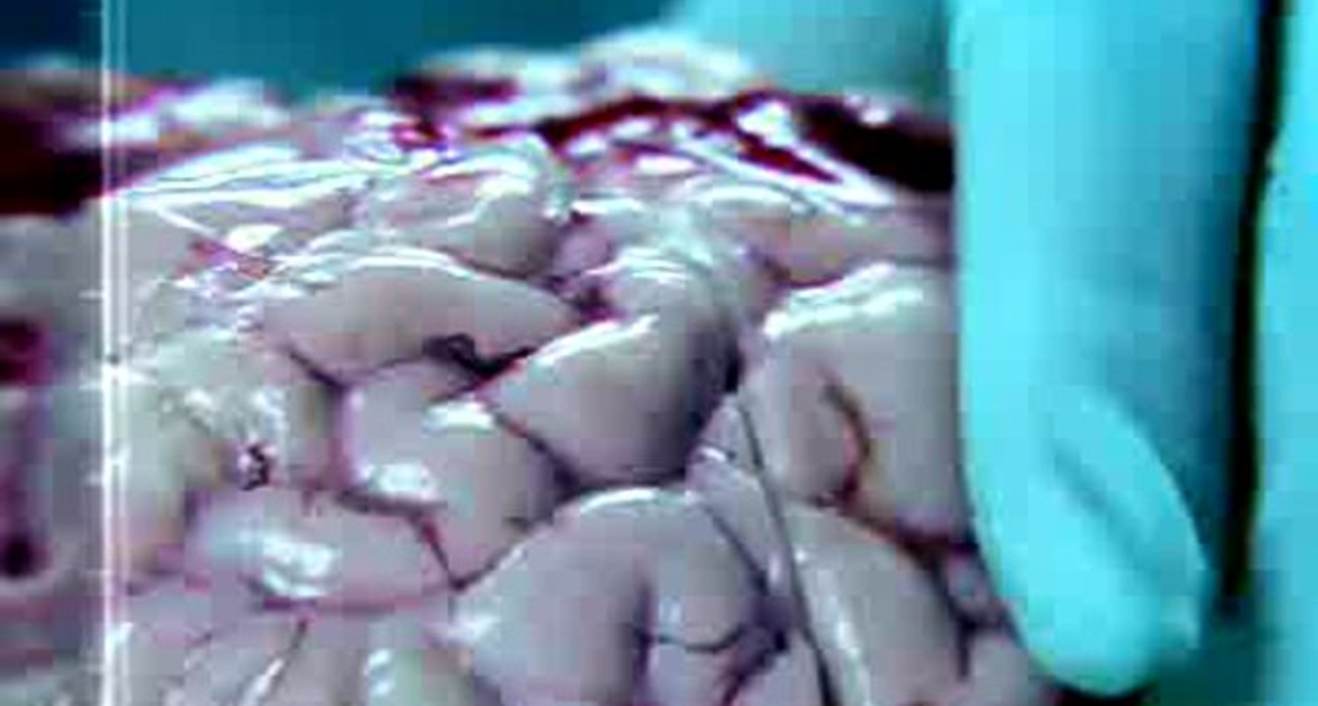 Вред курения - рак мозга