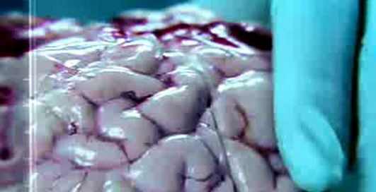 Вред курения - рак мозга