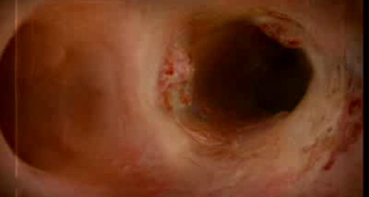 Вред курения - образование наростов в бронхах