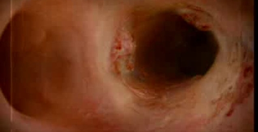 Вред курения - образование наростов в бронхах