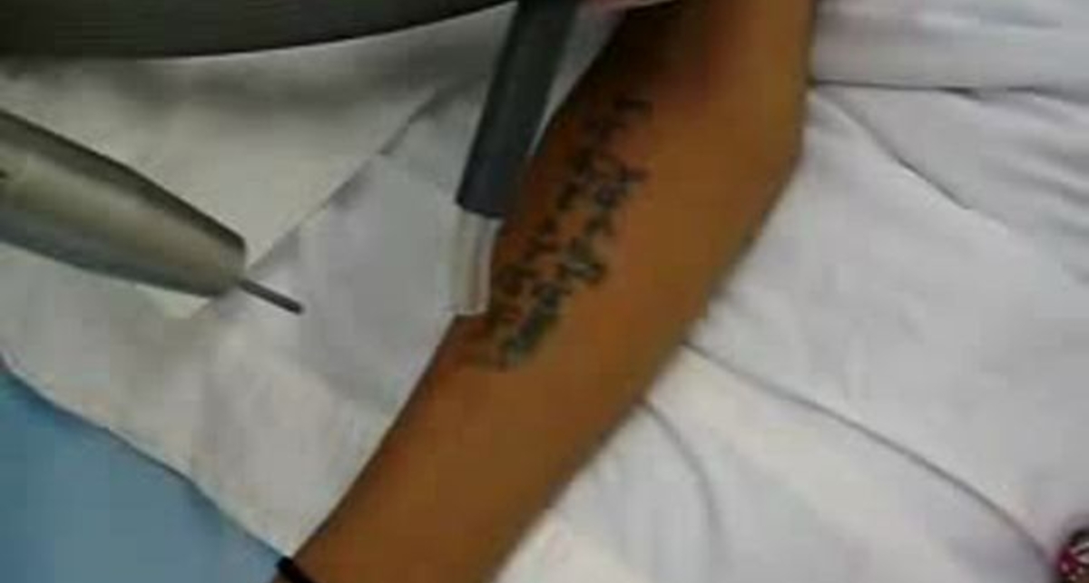 Удаляем татуировки