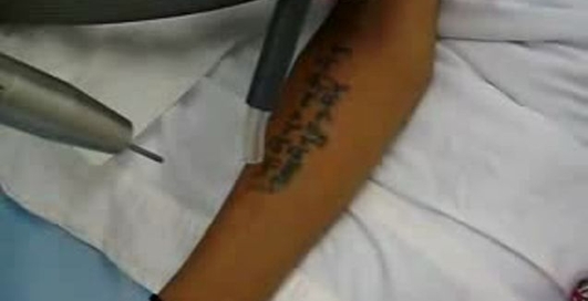 Удаляем татуировки