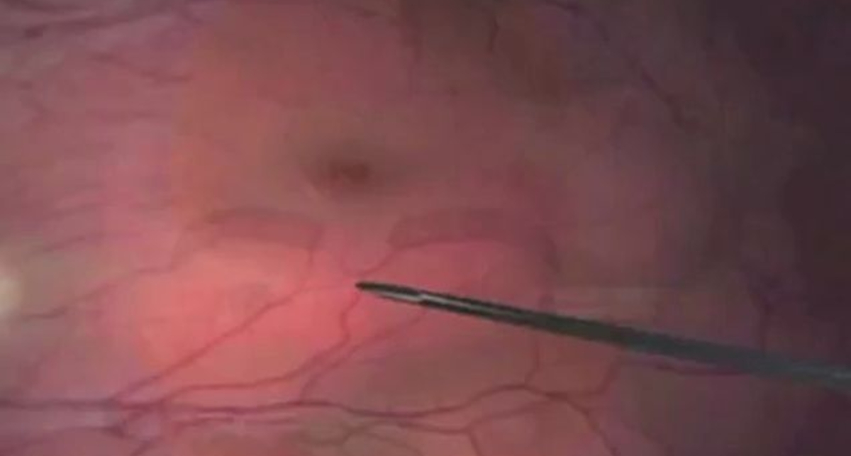 Микроробот в глазе