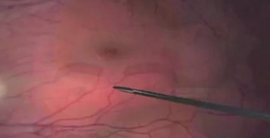 Микроробот в глазе