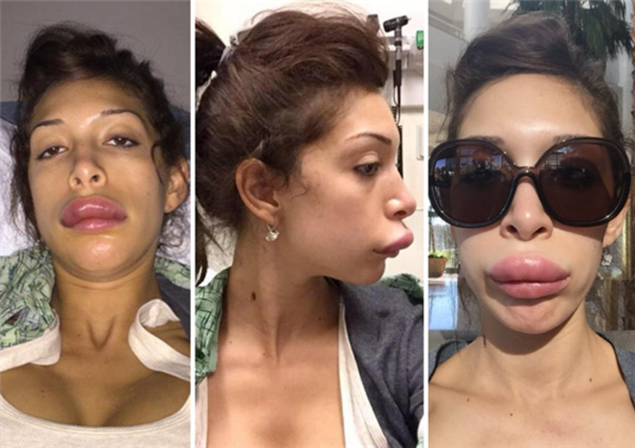 Звезды, испоганившие свои губы &quot;пластикой&quot;