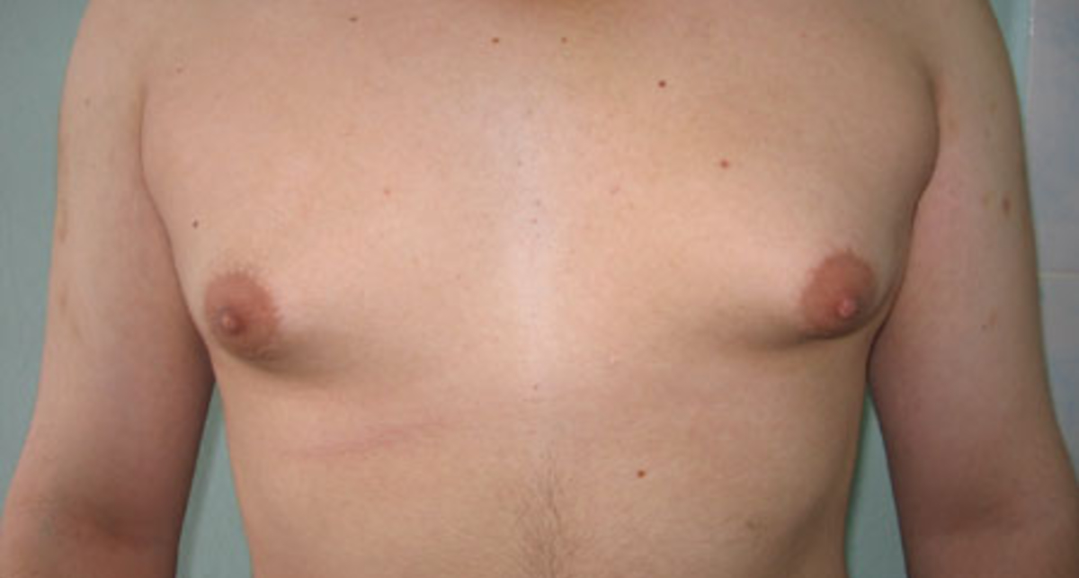 Гинекомастия, или «сучьи сиськи»