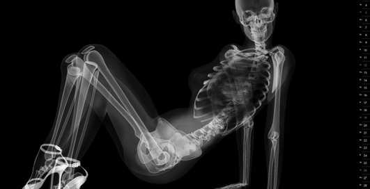 Пин-ап на рентгене: календарь с "сексуальными скелетиками"